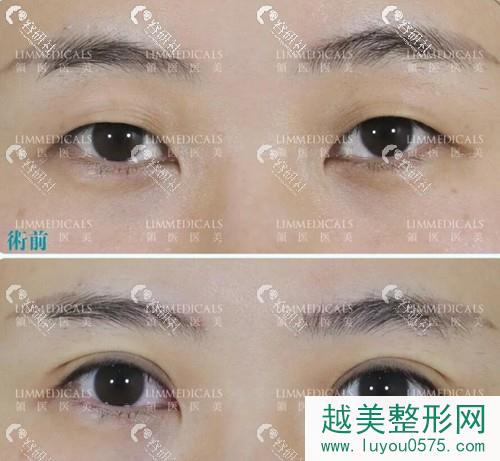 北京领医日式双眼皮术前术后术后果对比