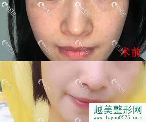 广州美莱医疗美容门诊部超激光美肤祛斑案例