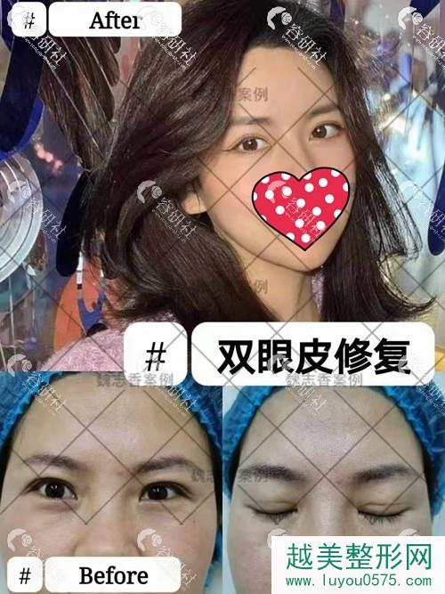 北京丽星翼美魏志香双眼皮修复案例