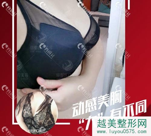 北京丽都假体隆胸案例