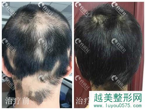 斑秃治疗方法 长春岳氏植发案例 斑秃治疗案例