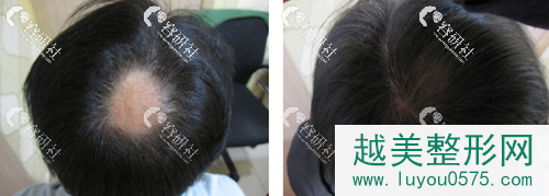 斑秃治疗方法 长春岳氏植发案例 斑秃治疗案例