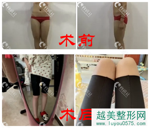 广州南珠阮正泉大腿吸脂案例