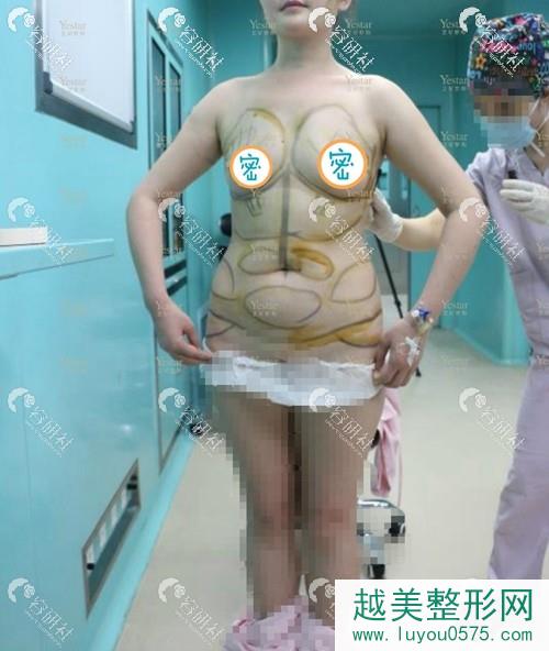 深圳艺星脂肪丰胸手术准备中
