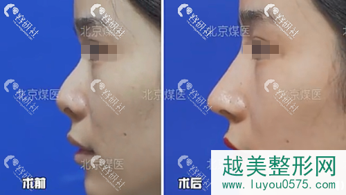 北京煤医隆鼻术前术后对比