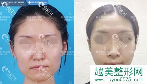 北京联合丽格医院何照华医生下颌角磨骨手术案例