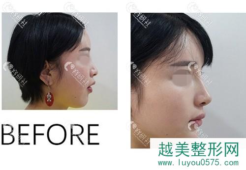 南京鼻祖鼻部手术改善案例