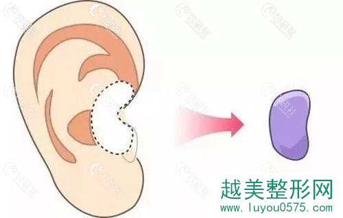     耳软骨隆鼻后会不会导致耳朵变形？