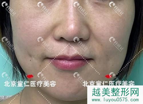北京童仁医疗美容欧素娇院长鼻基底填充术前