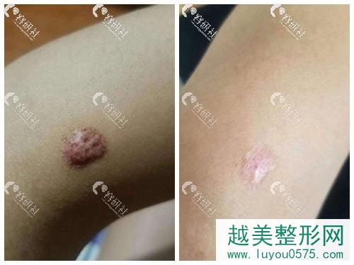 上海虹桥医院疙瘩疤痕前后对比照
