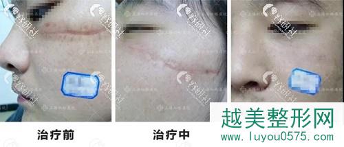 上海虹桥医院凹陷性疤痕前后对比照