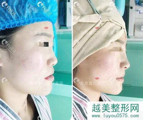 北京童仁假体垫鼻基底术前术后对比
