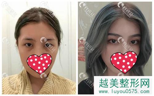 北京薇琳医疗美容医院双眼皮手术案例