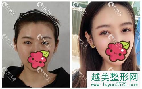 北京美莱医疗美容医院双眼皮手术案例