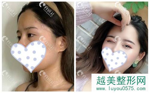 北京艺星医疗美容医院双眼皮手术案例
