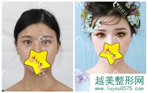 郑州华领医疗美容医院双眼皮手术案例