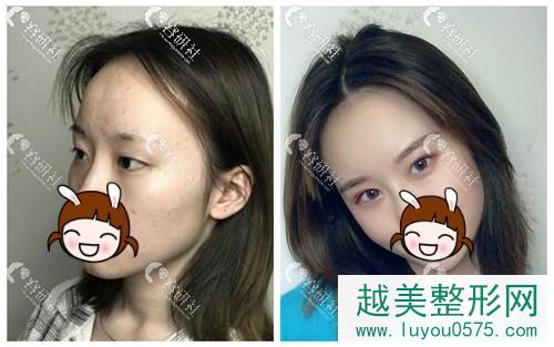 杭州薇琳医疗美容医院双眼皮手术案例