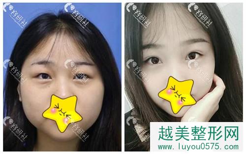 深圳健丽医疗美容门诊部双眼皮手术案例