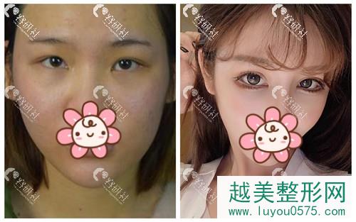 广东韩妃医疗美容医院双眼皮手术案例