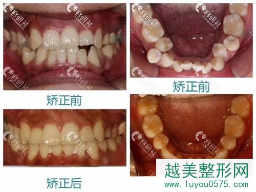 广州中家医家庭医生口腔医院牙齿矫正案例