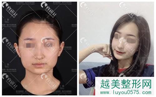 北京联合丽格医疗美容医院下颌角手术案例