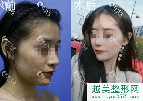杭州时光医疗美容医院下颌角手术案例