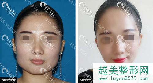 上海愉悦美联臣医疗美容医院下颌角手术案例