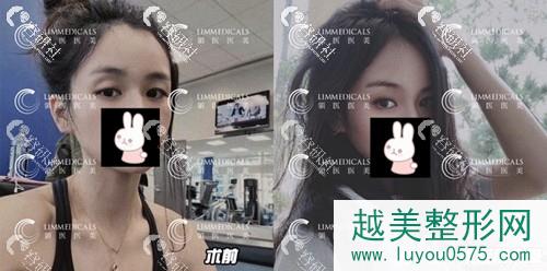 北京领医做日式微创双眼皮案例