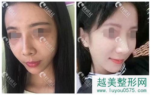广州美莱医疗美容门诊部鼻修复案例