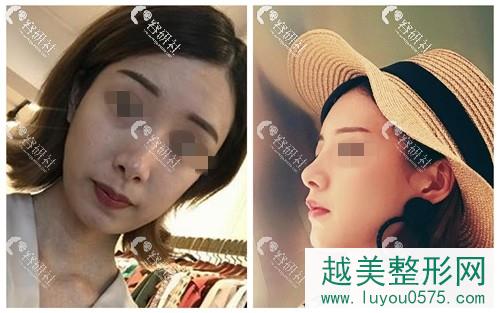 深圳艺星医疗美容医院鼻修复案例