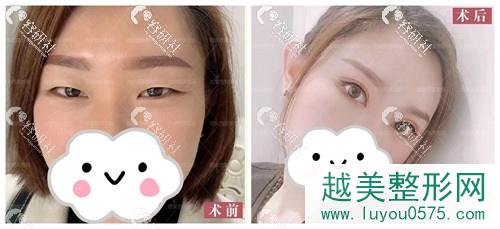 西安西美（西京）整形外科肿泡眼改善照片