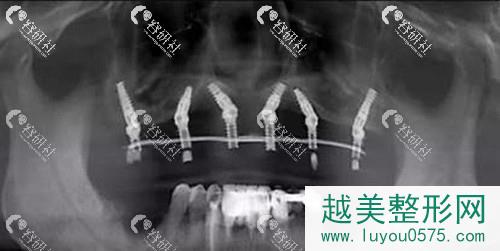 武汉同济医院口腔科种植牙价格是多少