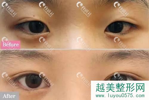 西安画美双眼皮修复案例对比图