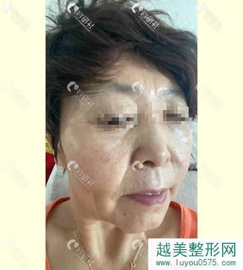 西美（西京）整形外科超激光美肤祛斑术后果照片
