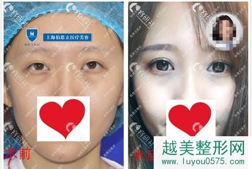 上海伯思立医院双眼皮修复案例