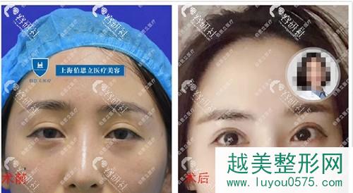 上海伯思立医院双眼皮修复案例对比