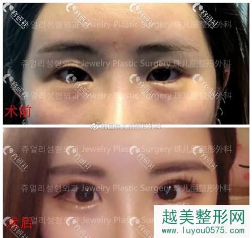 韩国珠儿丽医院做双眼皮修复案例