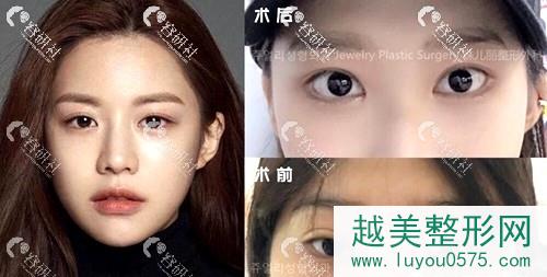 韩国珠儿丽医院做双眼皮修复案例对比图