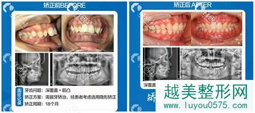 珠海九龙口腔医院龅牙矫正案例分享