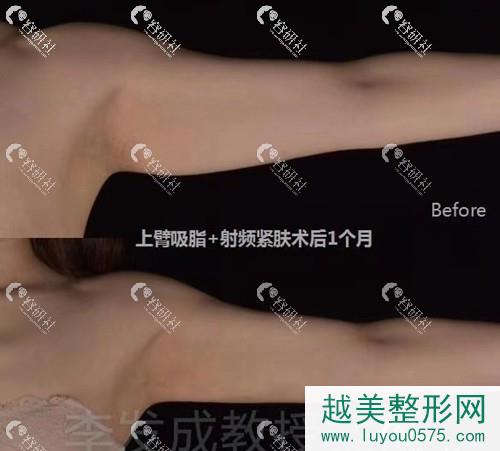 北京八大处李发成手臂吸脂案例