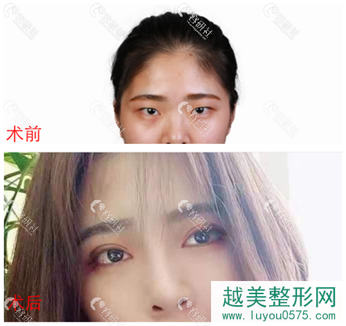 上海九院苏薇洁双眼皮修复案例