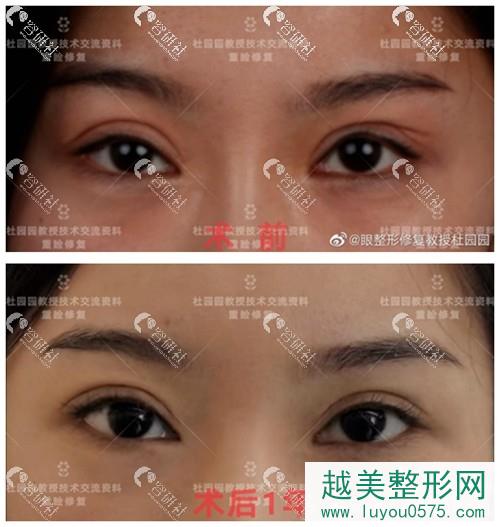 上海美莱杜园园医生双眼皮修复案例