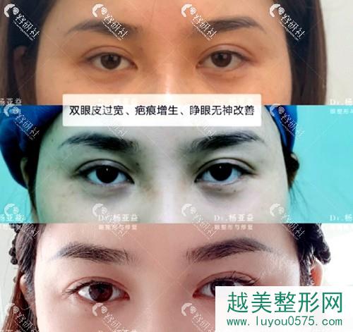 上海华美杨亚益医生双眼皮修复案例