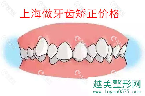 上海做牙齿矫正价格是多少