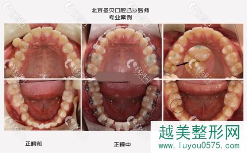 北京圣贝口腔门诊部牙齿矫正前后果对比