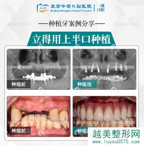 北京中诺口腔种植牙前后果对比