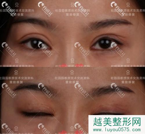 上海联合丽格杜园园双眼皮修复案例术前