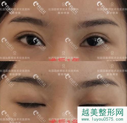 上海联合丽格杜园园双眼皮修复案例术后
