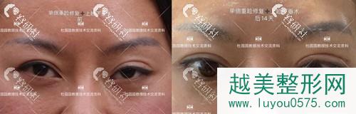 上海联合丽格杜园园双眼皮修复案例
