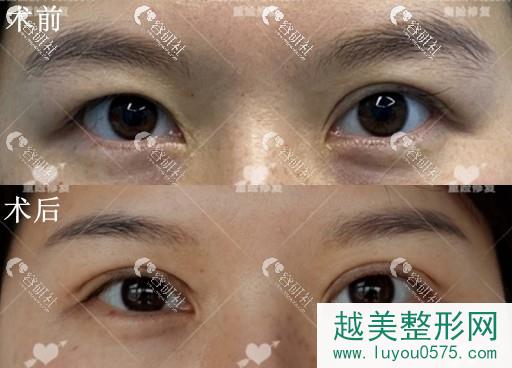 上海联合丽格杜园园双眼皮修复术前术后对比